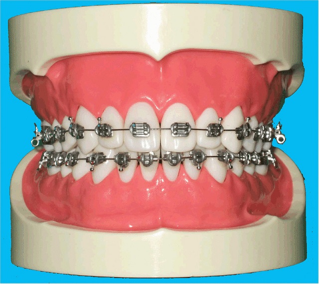 矯正装置 公式 こまざき矯正歯科クリニック